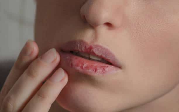 Comment soulager rapidement les lèvres gercées ?