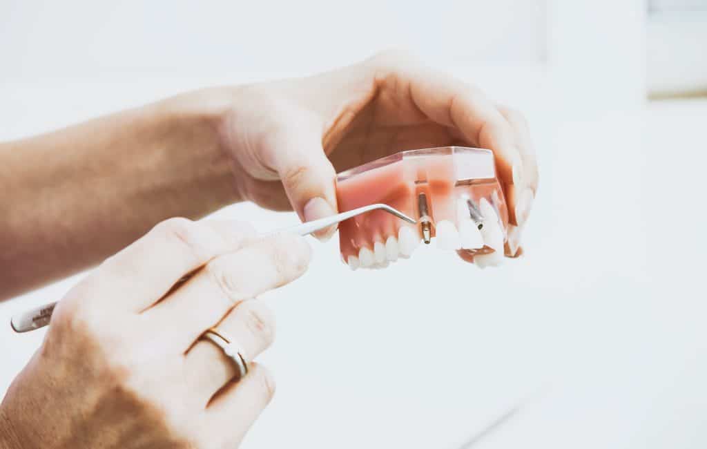 Dentiste avec une maquette de mâchoire montrant comment sont posés les implants dentaire