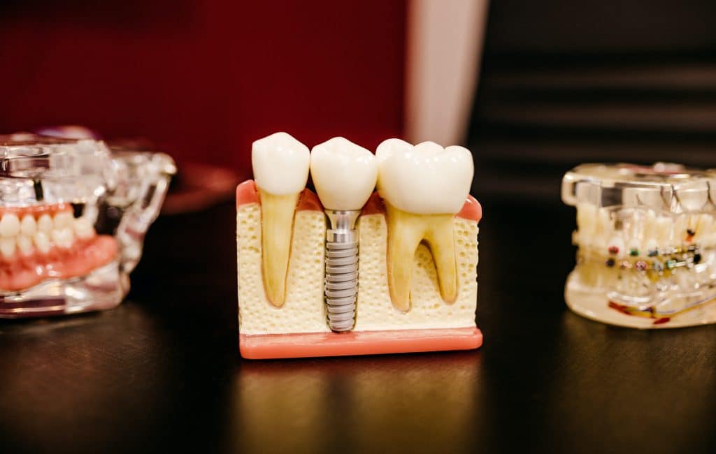 Maquette d'implant dentaire montrant les différences entre les implants et les dents naturelles