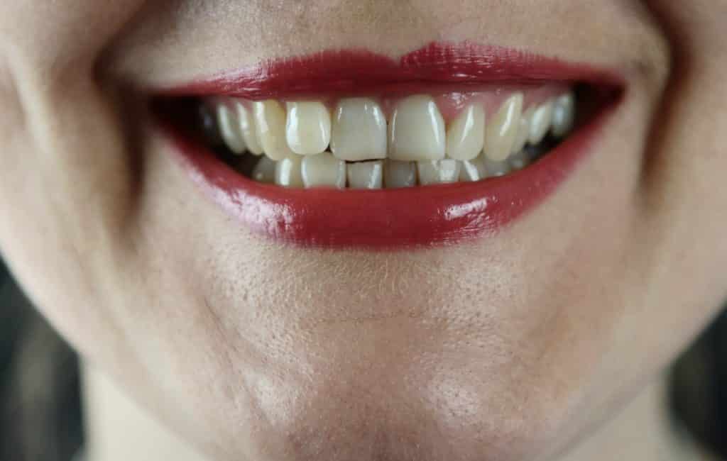 Dents mal alignées : Comment retrouver un beau sourire ?