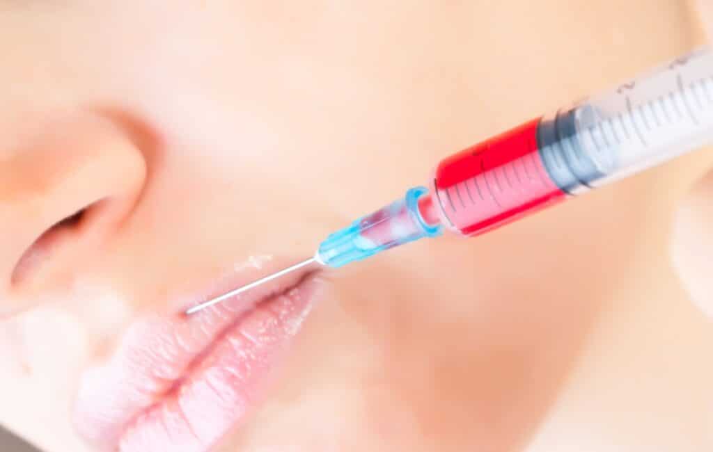 Injection dans une lèvre de femme pour de la médecine esthétique